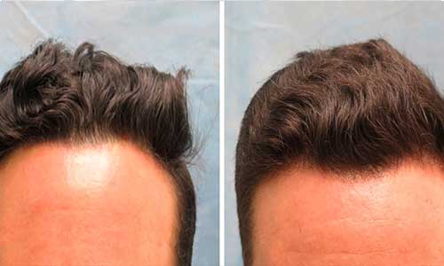 درمان ریزش مو با استفاده از پی آر پی