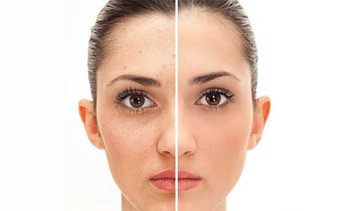 جوش های صورت به ما چه می گویند؟