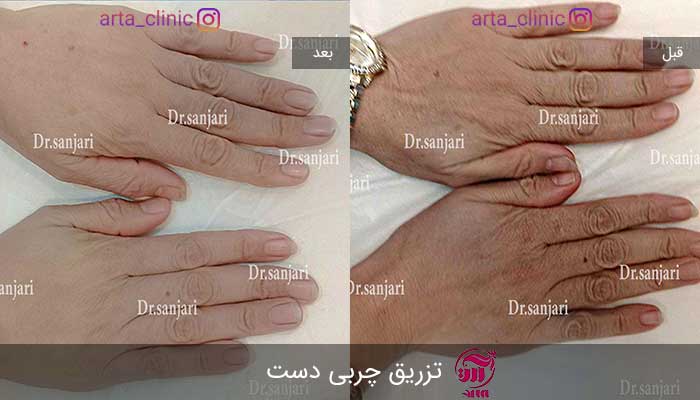 بهترین روش های جوانسازی پوست دست