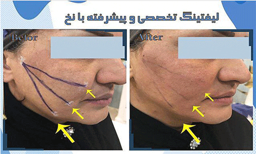 لیفت تخصصی و پیشرفته با نخ