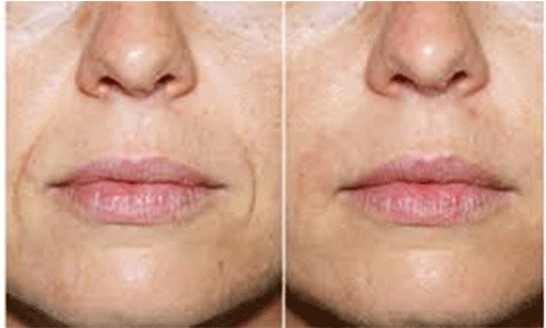 تزریق ژل خط خنده