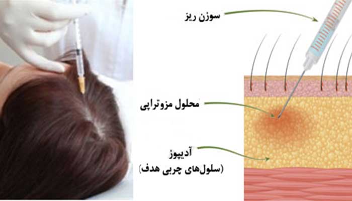انجام مزو تراپی برای درمان و جلوگیری از ریزش مو